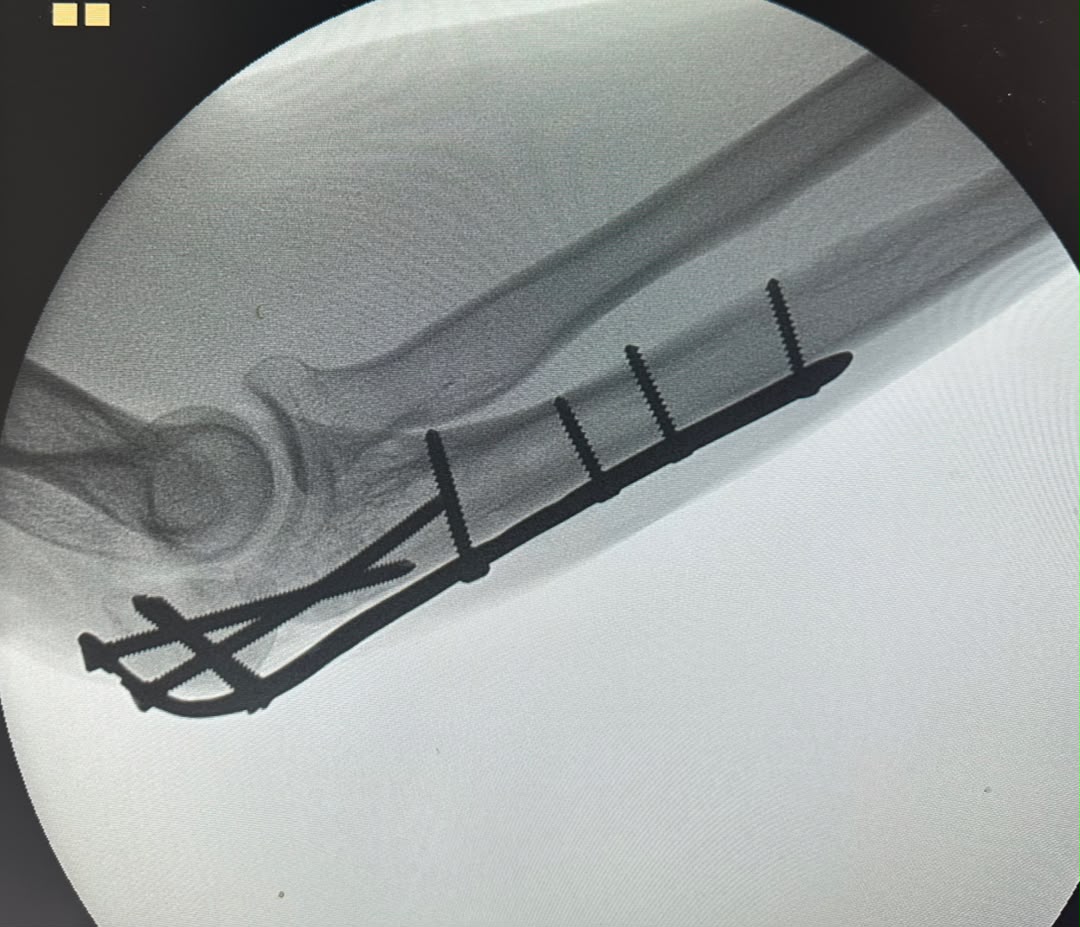 fracture